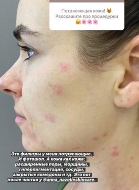 Ирена Понарошку показала, как на самом деле выглядит ее кожа