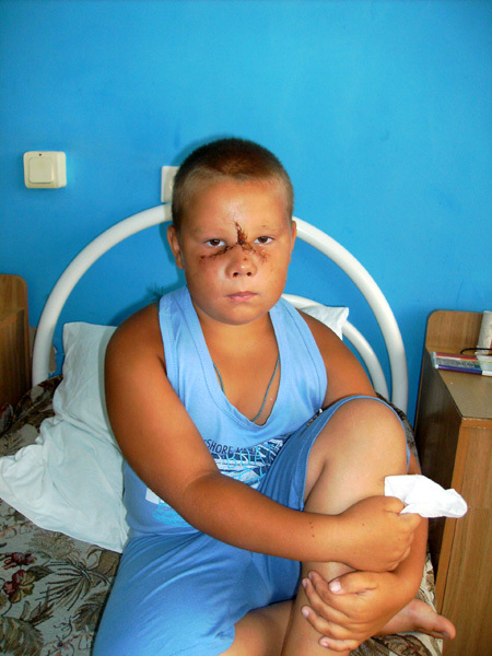 Нос у Кирилла БОЛОТОВА держался на лоскуте кожи