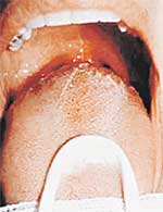 ВЕРТИТСЯ НА ЯЗЫКЕ: в несколько приемов следует соскрести налет и слизь